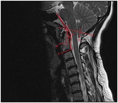 The role of ONSD in the assessment of headache associated with Chiari malformation type 1